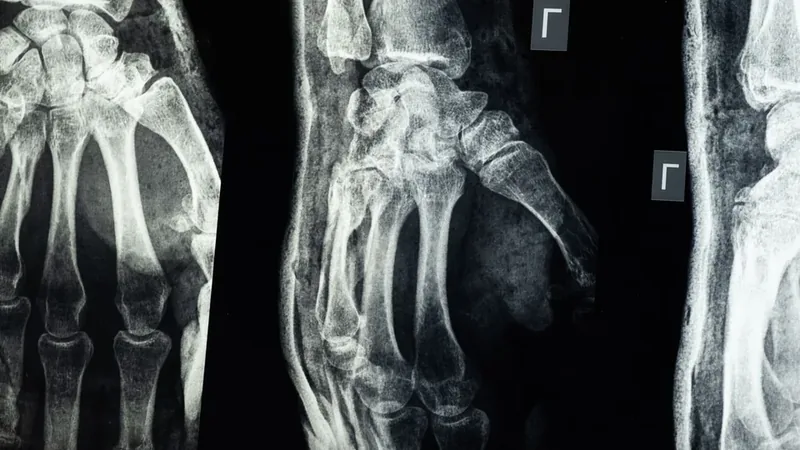 Radiografia da mão e do punho mostrando os ossos do carpo, exame usado na fratura de escafoide